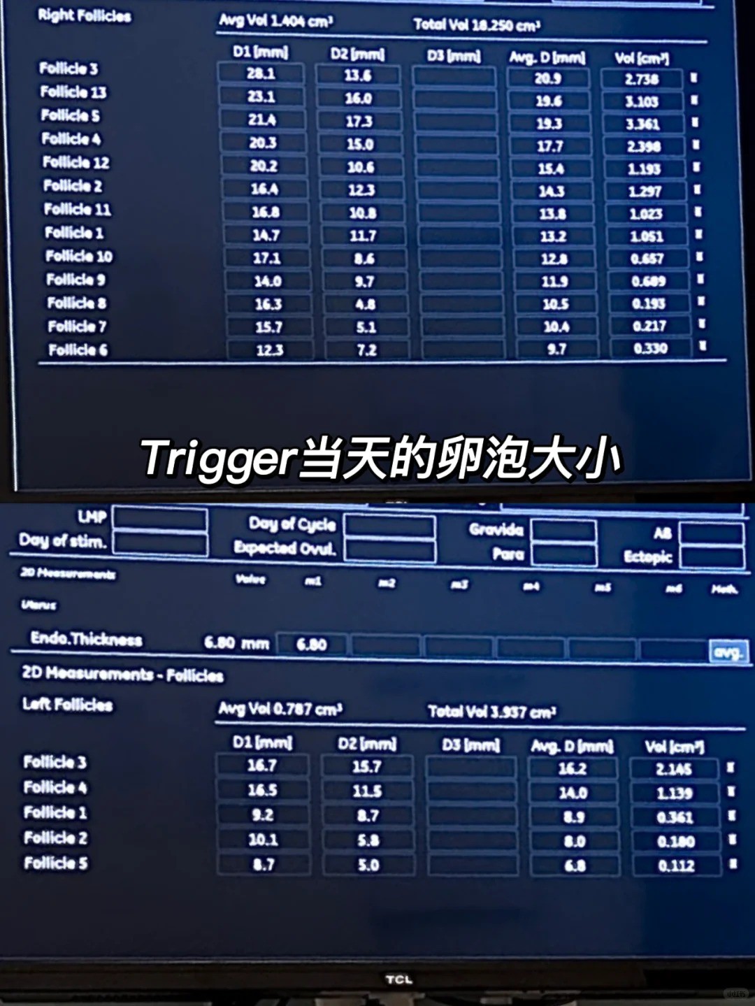 美国IVF日记｜取卵16颗➕促排方案分享