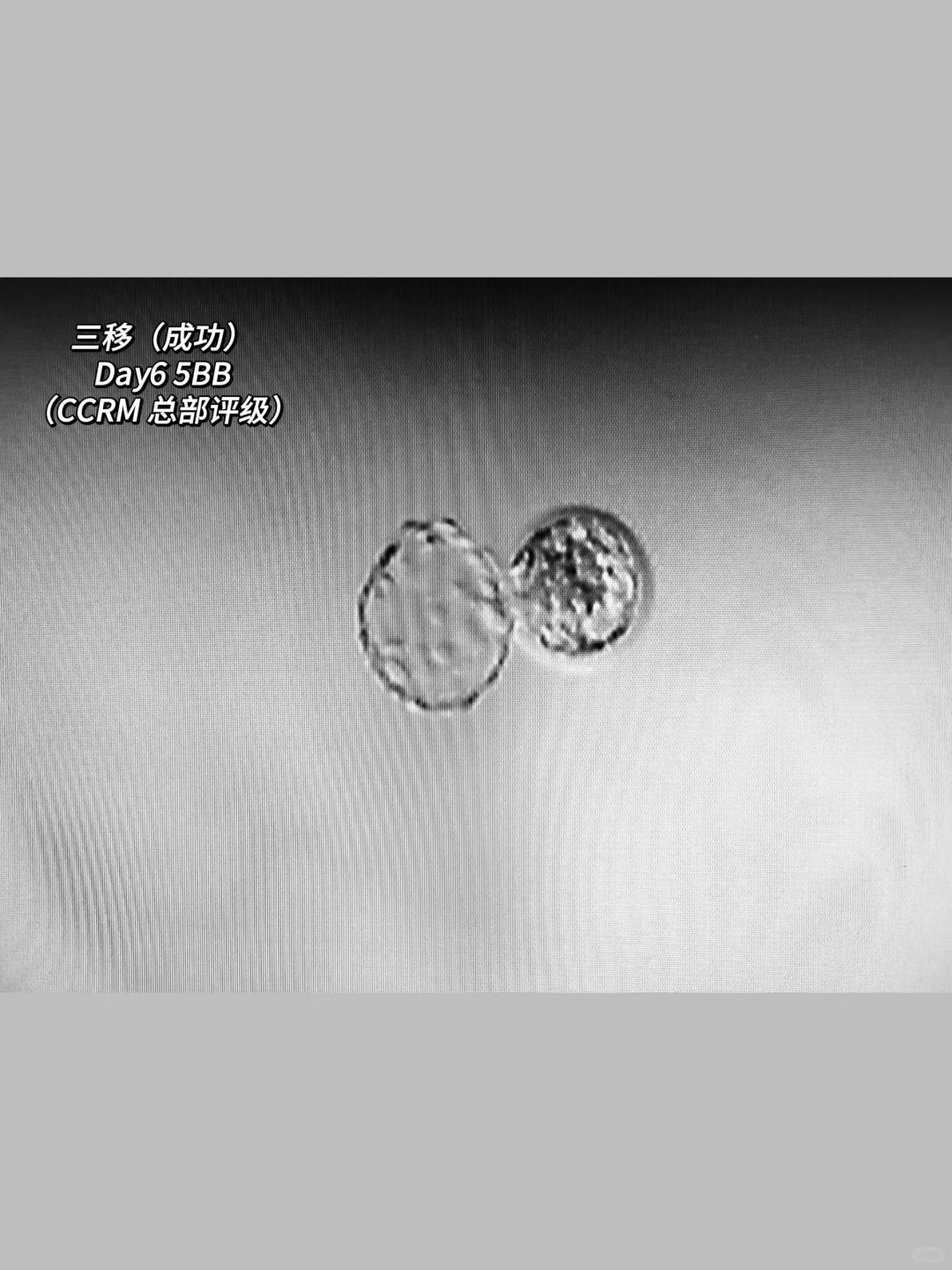 IVF第三次移植上岸｜回国保胎经验分享